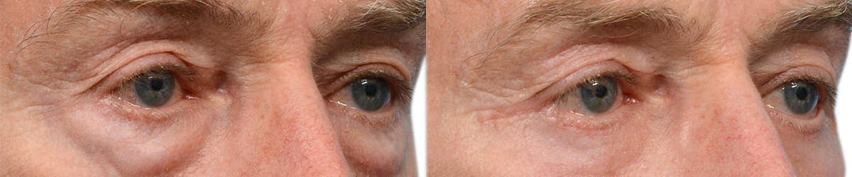Blepharoplasty (Eyelid Surgery) Before & After Gallery - Patient 391037 - Image 2
