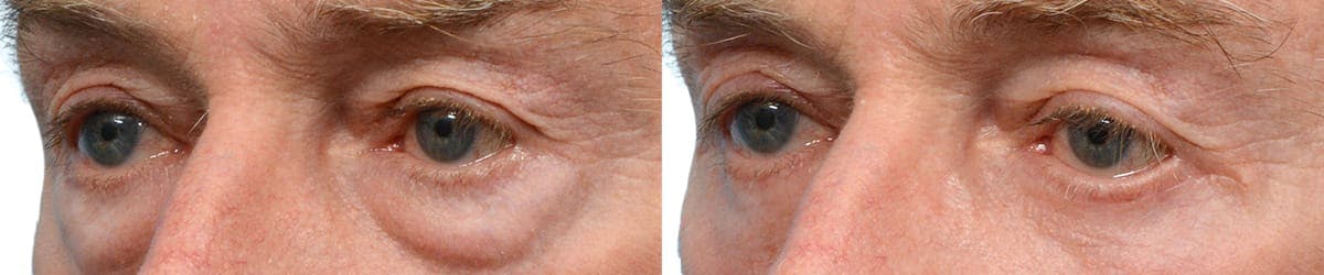 Blepharoplasty (Eyelid Surgery) Before & After Gallery - Patient 391037 - Image 3