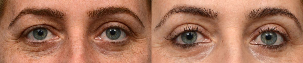 Blepharoplasty (Eyelid Surgery) Before & After Gallery - Patient 132683 - Image 1