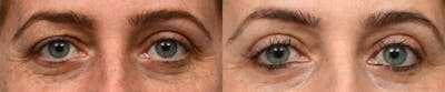 Blepharoplasty (Eyelid Surgery) Before & After Gallery - Patient 132683 - Image 1