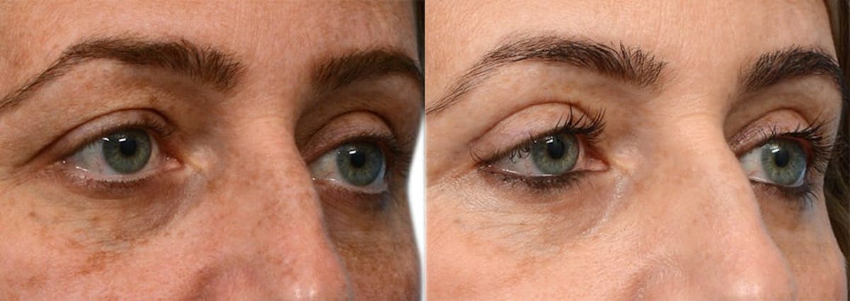 Blepharoplasty (Eyelid Surgery) Before & After Gallery - Patient 132683 - Image 2
