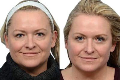 Blepharoplasty (Eyelid Surgery) Before & After Gallery - Patient 170425 - Image 1