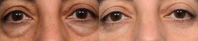 Blepharoplasty (Eyelid Surgery) Before & After Gallery - Patient 386800 - Image 1