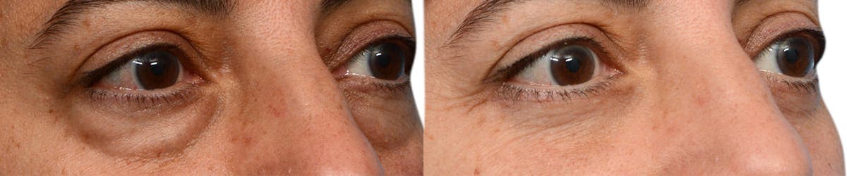 Blepharoplasty (Eyelid Surgery) Before & After Gallery - Patient 386800 - Image 2