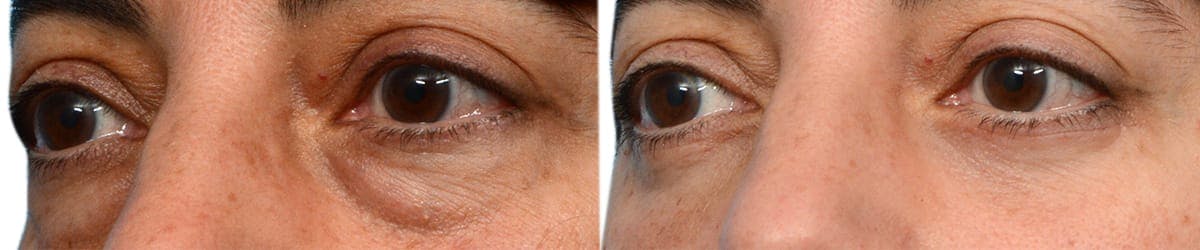 Blepharoplasty (Eyelid Surgery) Before & After Gallery - Patient 386800 - Image 3