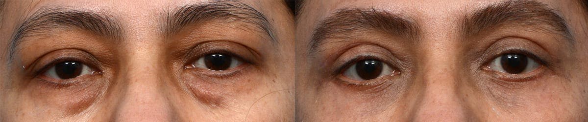 Blepharoplasty (Eyelid Surgery) Before & After Gallery - Patient 409769 - Image 1
