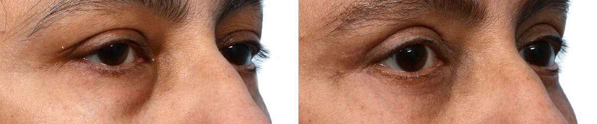 Blepharoplasty (Eyelid Surgery) Before & After Gallery - Patient 409769 - Image 2