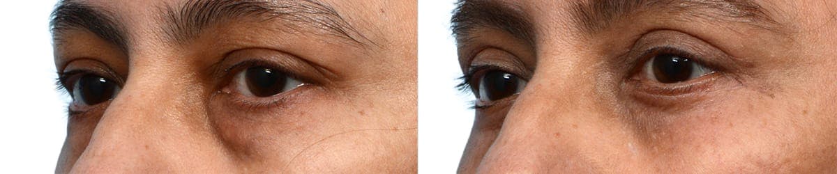 Blepharoplasty (Eyelid Surgery) Before & After Gallery - Patient 409769 - Image 3