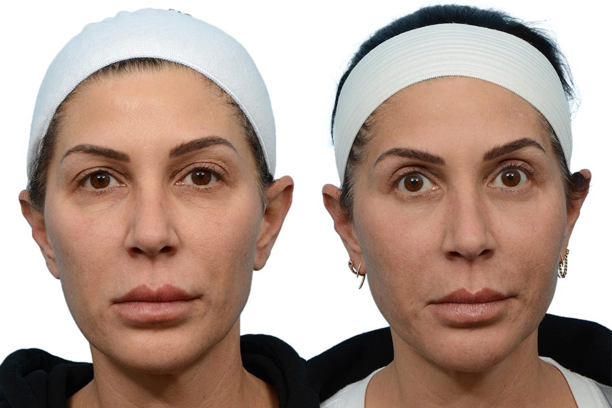 Blepharoplasty (Eyelid Surgery) Before & After Gallery - Patient 305182 - Image 1