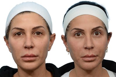 Blepharoplasty (Eyelid Surgery) Before & After Gallery - Patient 305182 - Image 1