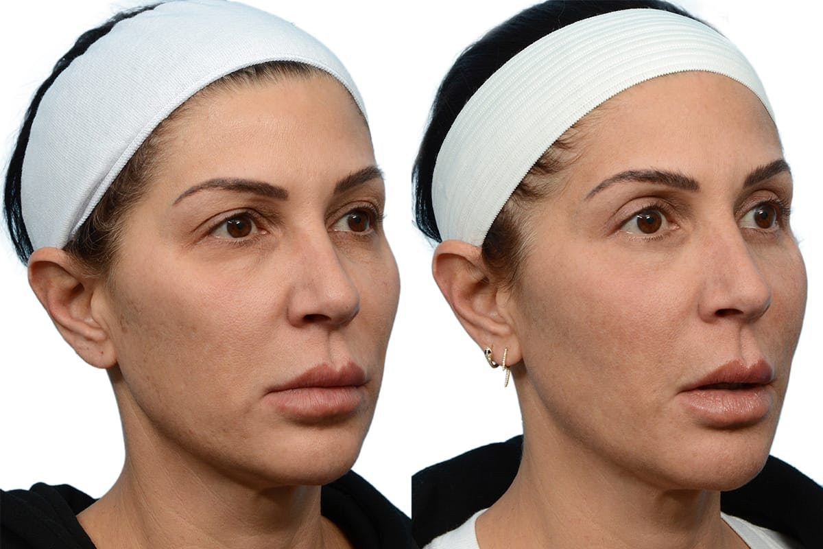 Blepharoplasty (Eyelid Surgery) Before & After Gallery - Patient 305182 - Image 2
