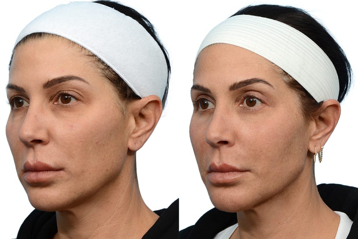 Blepharoplasty (Eyelid Surgery) Before & After Gallery - Patient 305182 - Image 3