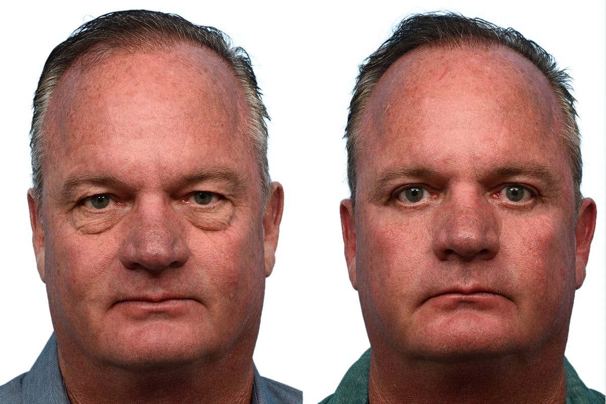 Blepharoplasty (Eyelid Surgery) Before & After Gallery - Patient 426564 - Image 1