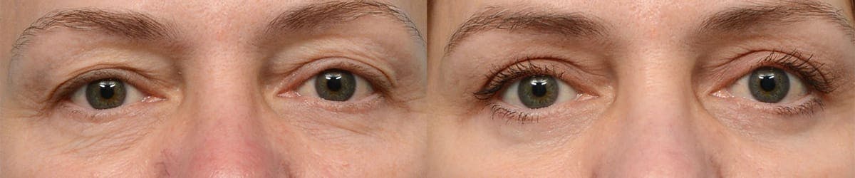 Blepharoplasty (Eyelid Surgery) Before & After Gallery - Patient 679906 - Image 1