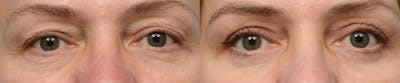 Blepharoplasty (Eyelid Surgery) Before & After Gallery - Patient 679906 - Image 1