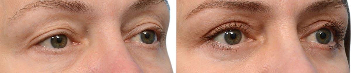 Blepharoplasty (Eyelid Surgery) Before & After Gallery - Patient 679906 - Image 2