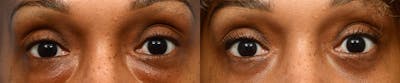 Blepharoplasty (Eyelid Surgery) Before & After Gallery - Patient 340026 - Image 1