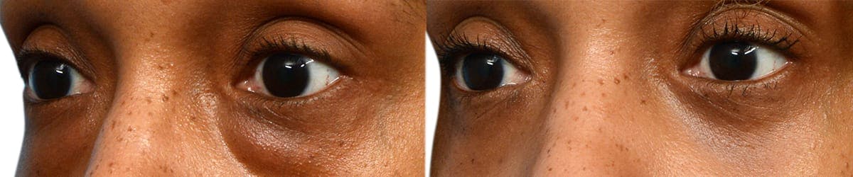 Blepharoplasty (Eyelid Surgery) Before & After Gallery - Patient 340026 - Image 3
