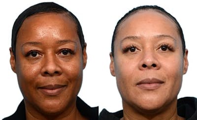 Blepharoplasty (Eyelid Surgery) Before & After Gallery - Patient 165716 - Image 1