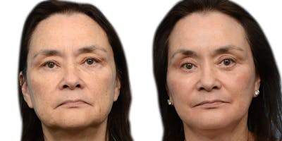 Blepharoplasty (Eyelid Surgery) Before & After Gallery - Patient 346117 - Image 1
