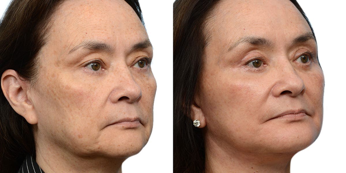 Blepharoplasty (Eyelid Surgery) Before & After Gallery - Patient 346117 - Image 2