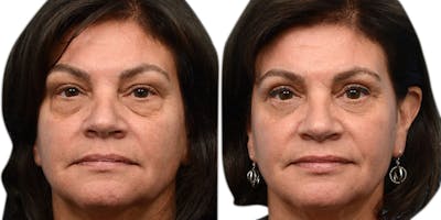 Blepharoplasty (Eyelid Surgery) Before & After Gallery - Patient 318385 - Image 1