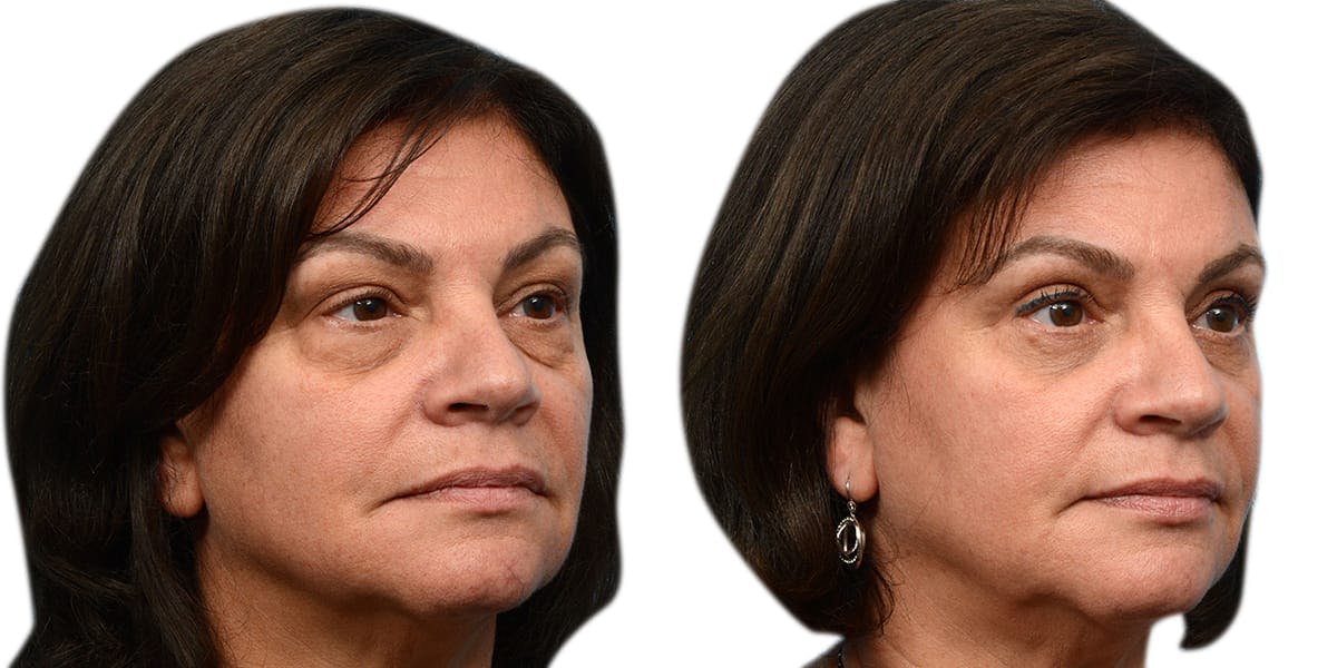 Blepharoplasty (Eyelid Surgery) Before & After Gallery - Patient 318385 - Image 2