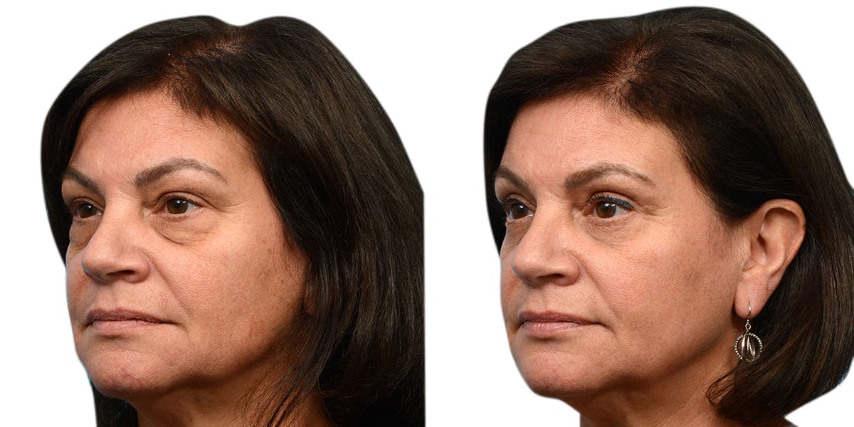Blepharoplasty (Eyelid Surgery) Before & After Gallery - Patient 318385 - Image 3