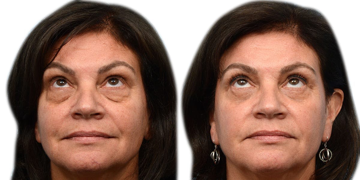 Blepharoplasty (Eyelid Surgery) Before & After Gallery - Patient 318385 - Image 4