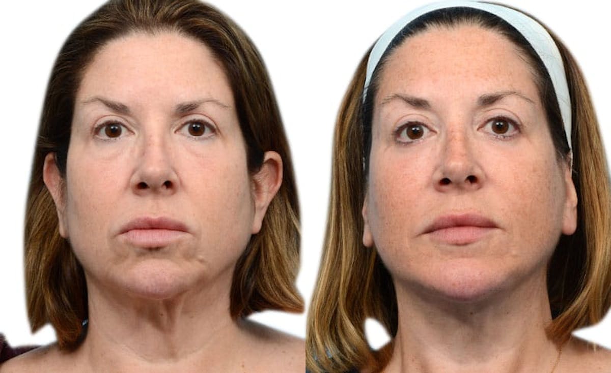 Blepharoplasty (Eyelid Surgery) Before & After Gallery - Patient 827946 - Image 1