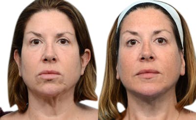 Blepharoplasty (Eyelid Surgery) Before & After Gallery - Patient 827946 - Image 1