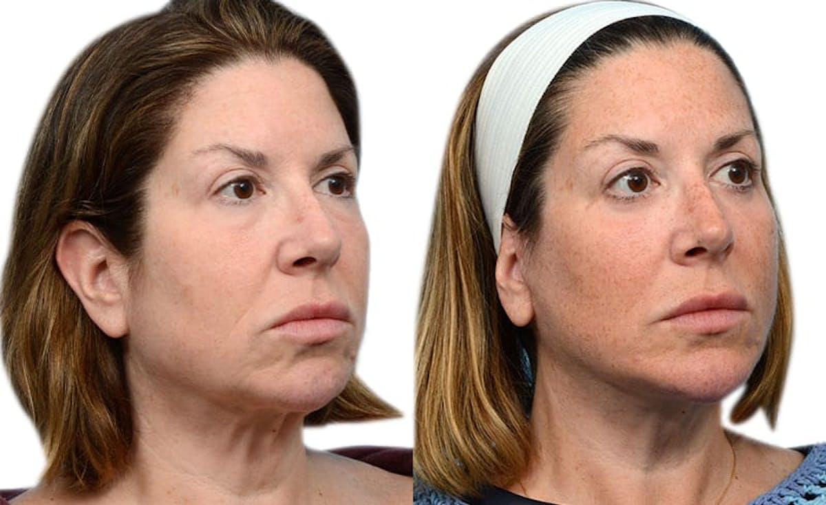 Blepharoplasty (Eyelid Surgery) Before & After Gallery - Patient 827946 - Image 2