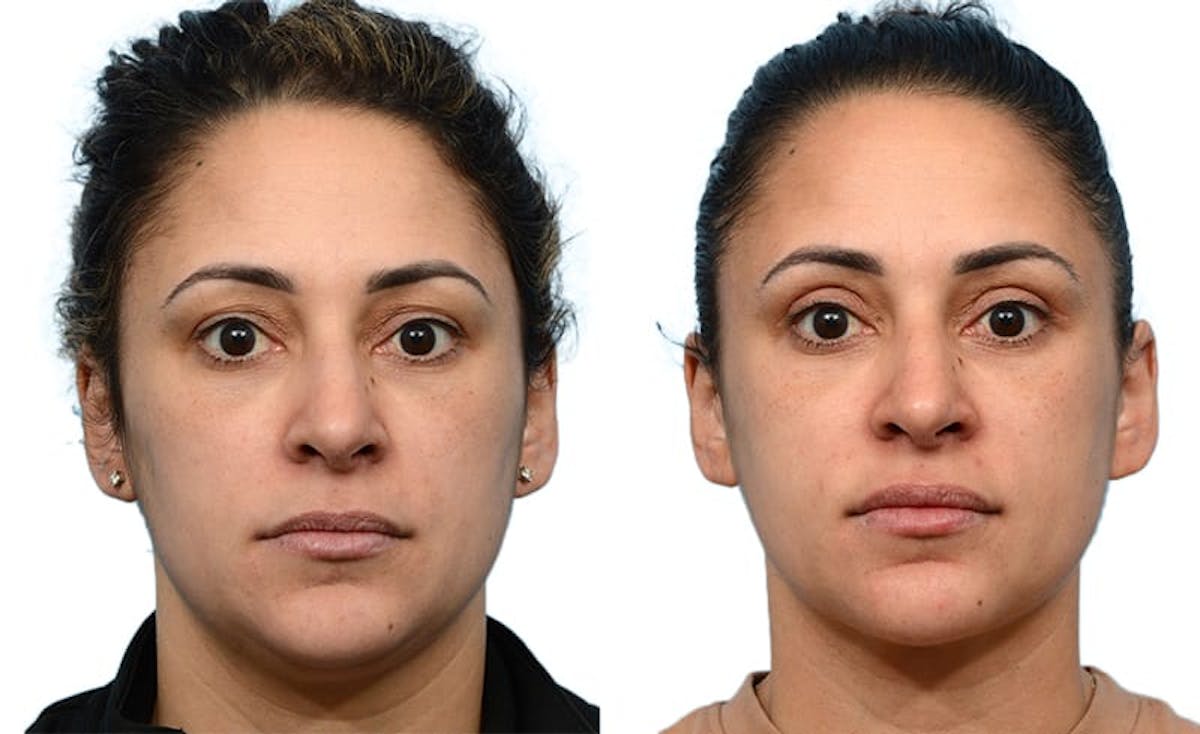 Blepharoplasty (Eyelid Surgery) Before & After Gallery - Patient 796072 - Image 1
