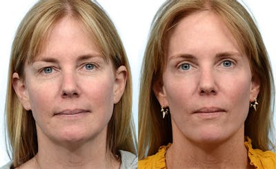 Blepharoplasty (Eyelid Surgery) Before & After Gallery - Patient 392829 - Image 1