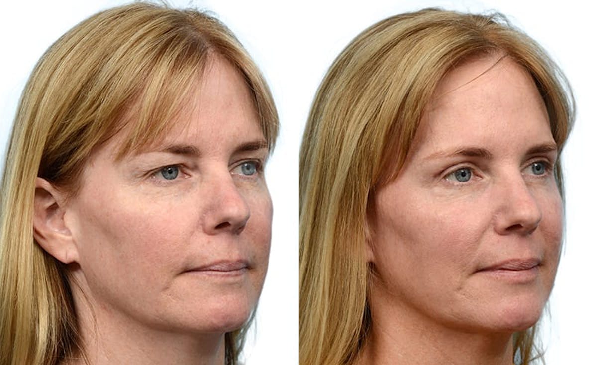 Blepharoplasty (Eyelid Surgery) Before & After Gallery - Patient 392829 - Image 2