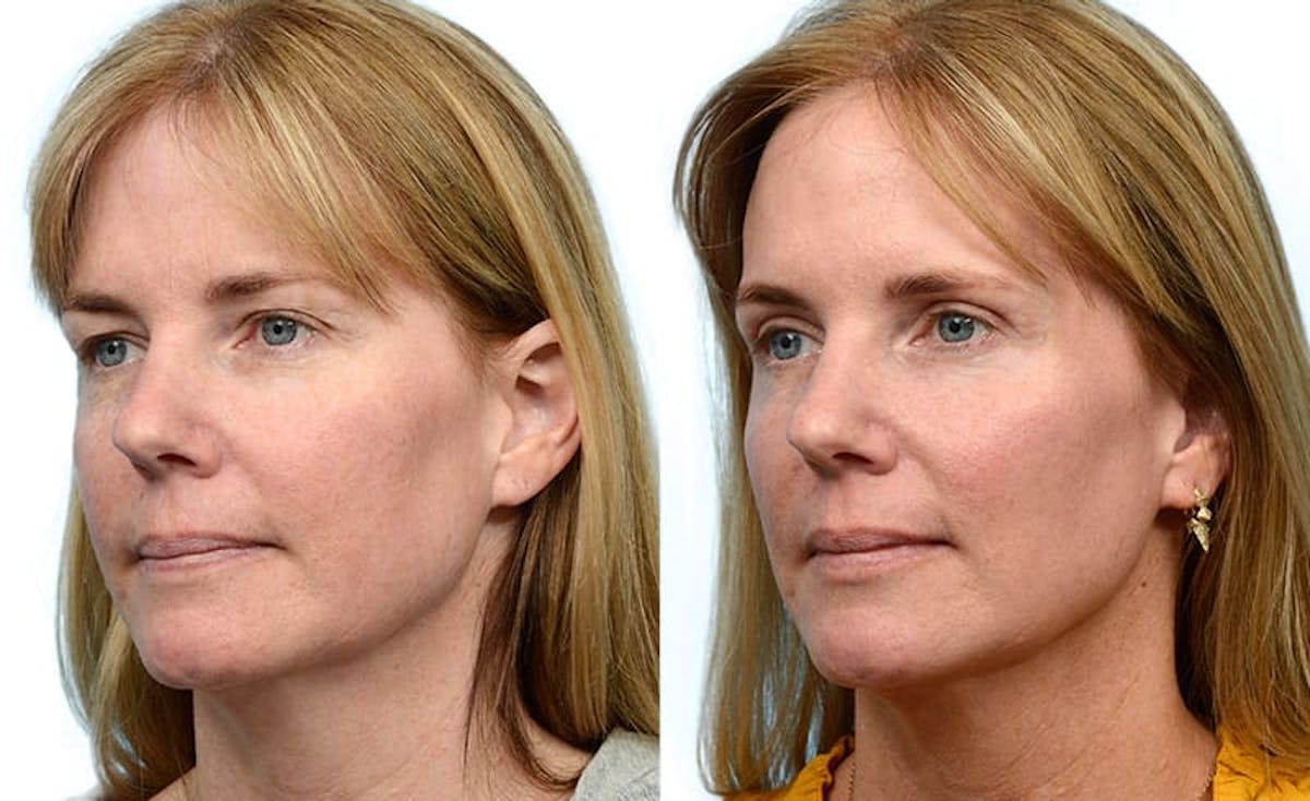 Blepharoplasty (Eyelid Surgery) Before & After Gallery - Patient 392829 - Image 3