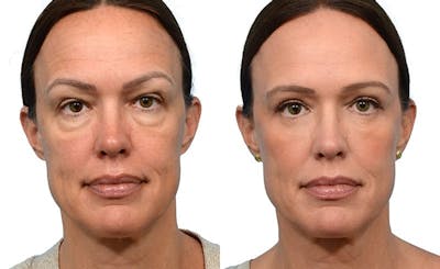 Blepharoplasty (Eyelid Surgery) Before & After Gallery - Patient 353077 - Image 1