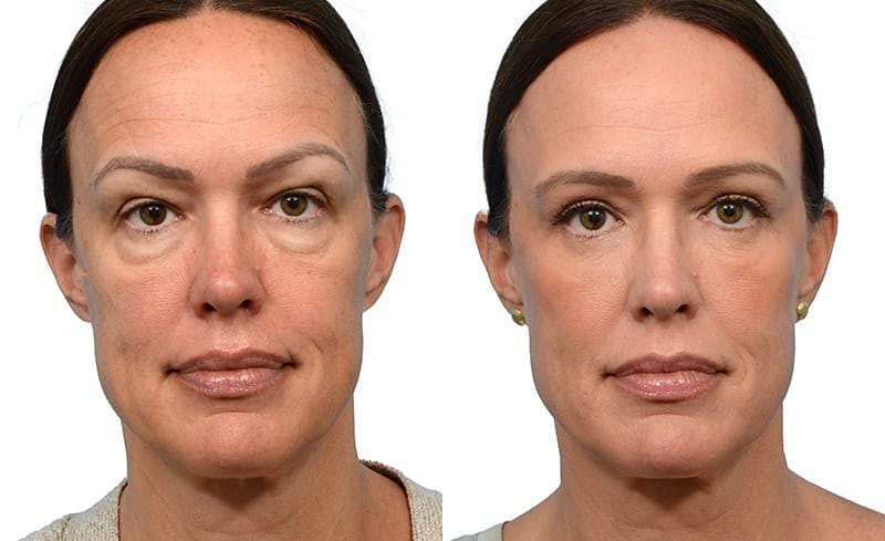 Blepharoplasty (Eyelid Surgery) Before & After Gallery - Patient 353077 - Image 1