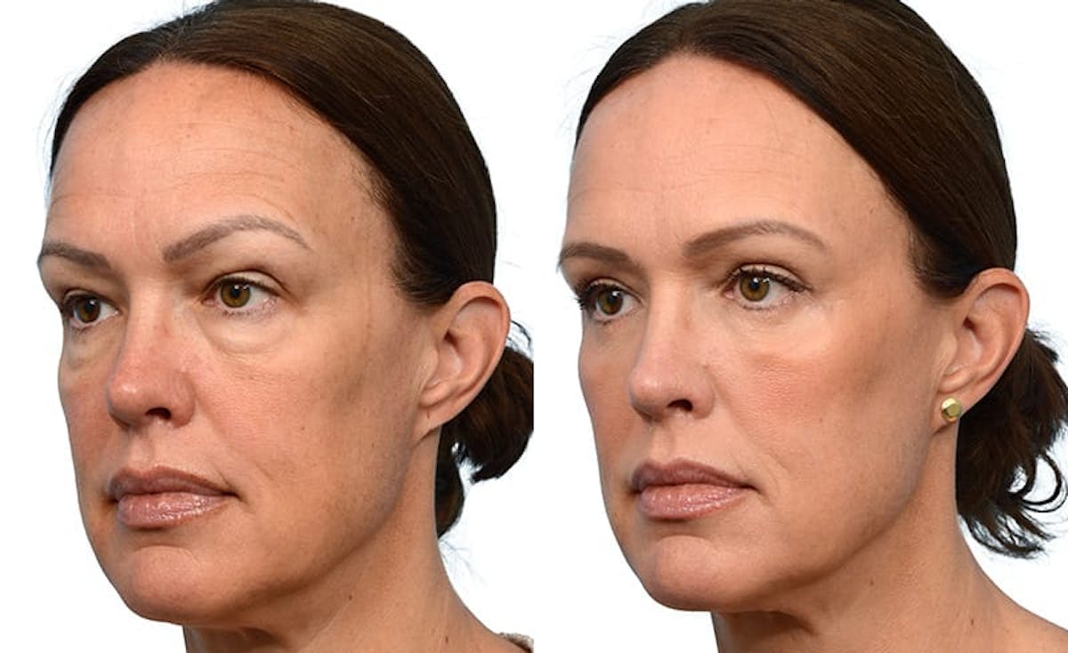 Blepharoplasty (Eyelid Surgery) Before & After Gallery - Patient 353077 - Image 3