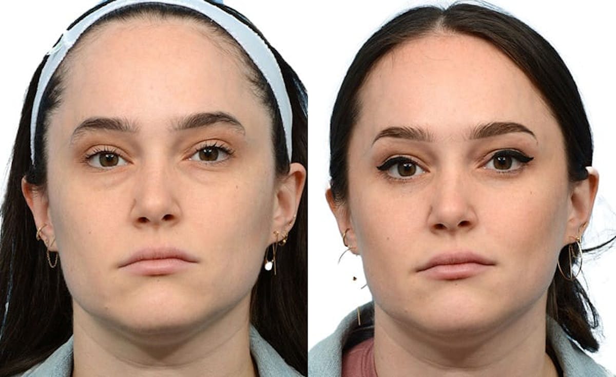 Blepharoplasty (Eyelid Surgery) Before & After Gallery - Patient 231727 - Image 1