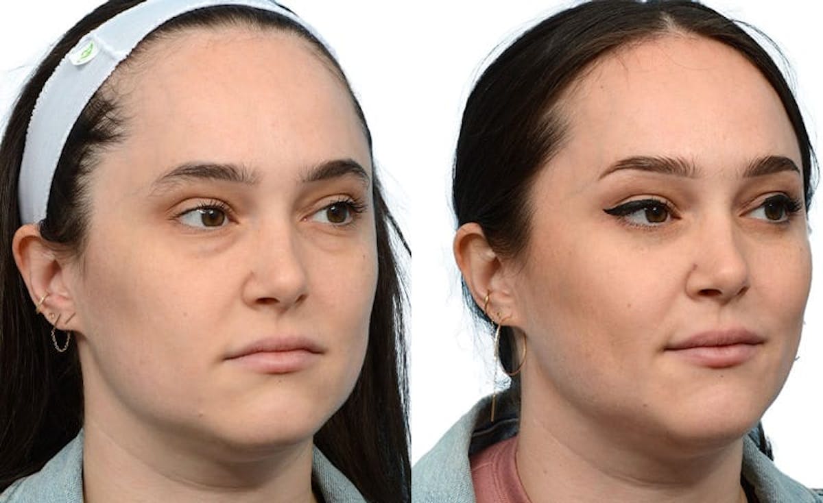 Blepharoplasty (Eyelid Surgery) Before & After Gallery - Patient 231727 - Image 2