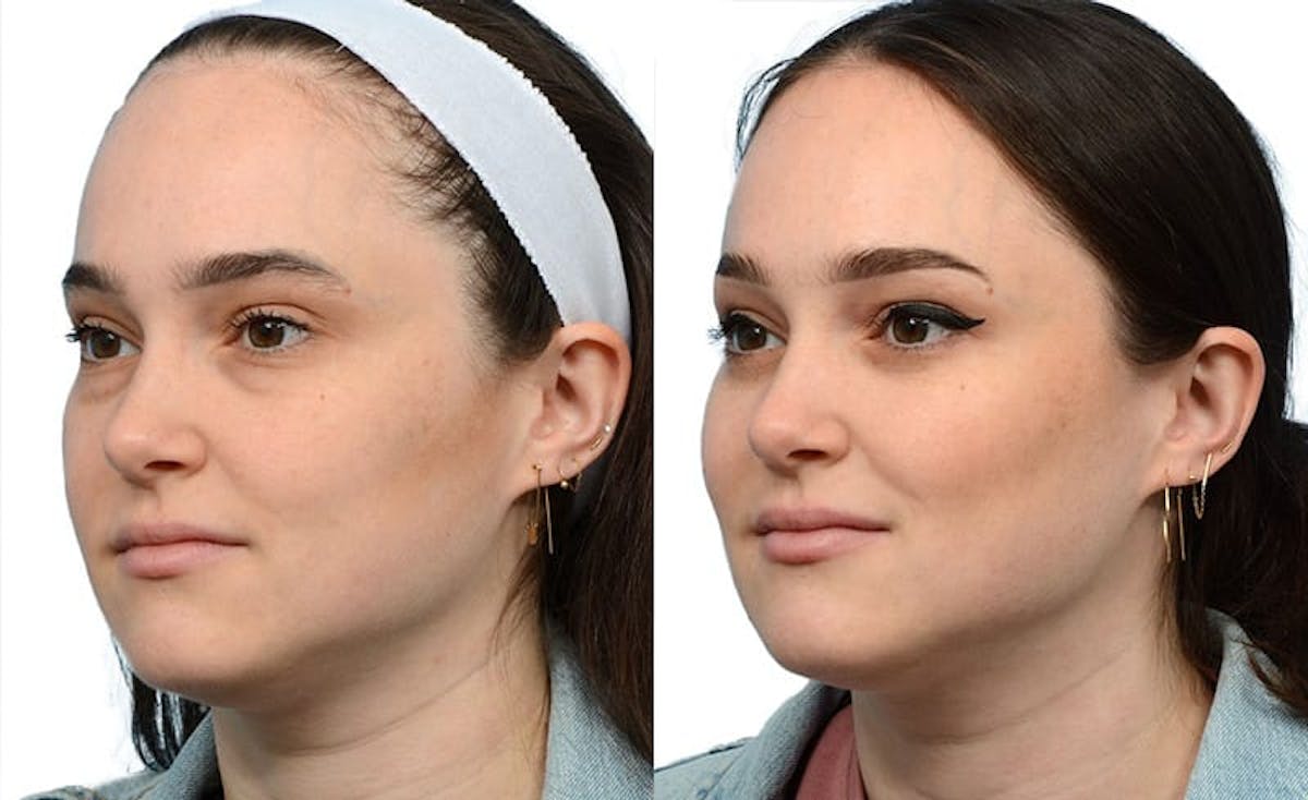 Blepharoplasty (Eyelid Surgery) Before & After Gallery - Patient 231727 - Image 4