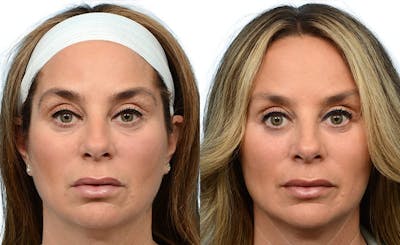 Blepharoplasty (Eyelid Surgery) Before & After Gallery - Patient 128270 - Image 1