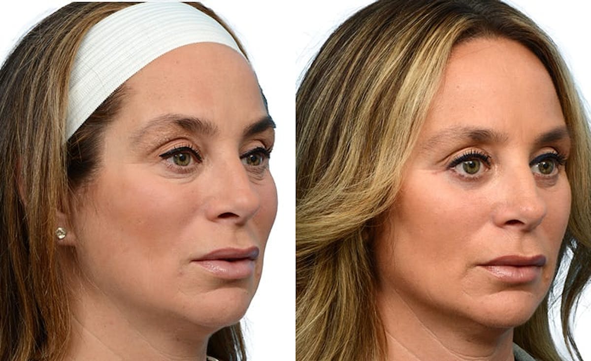 Blepharoplasty (Eyelid Surgery) Before & After Gallery - Patient 128270 - Image 2
