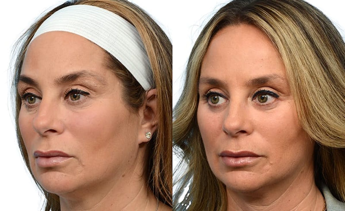 Blepharoplasty (Eyelid Surgery) Before & After Gallery - Patient 128270 - Image 3