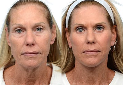 Blepharoplasty (Eyelid Surgery) Before & After Gallery - Patient 401128 - Image 1