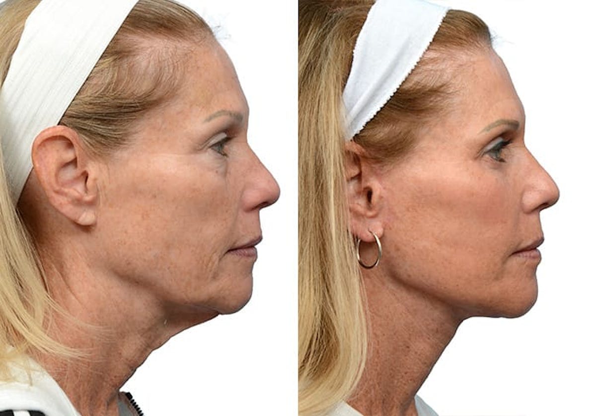 Blepharoplasty (Eyelid Surgery) Before & After Gallery - Patient 401128 - Image 2