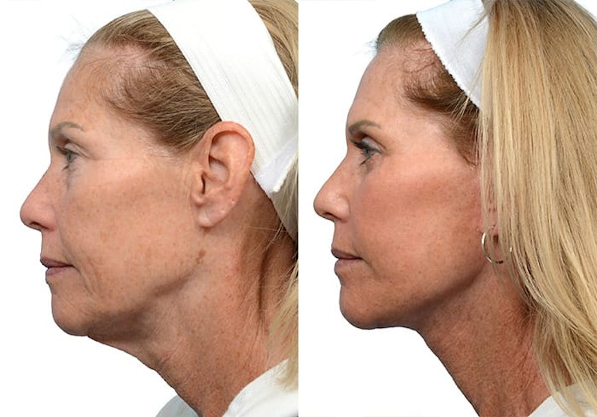 Blepharoplasty (Eyelid Surgery) Before & After Gallery - Patient 401128 - Image 3