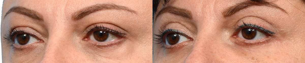 Blepharoplasty (Eyelid Surgery) Before & After Gallery - Patient 137677 - Image 1