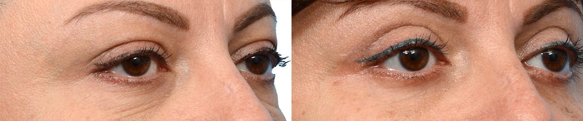 Blepharoplasty (Eyelid Surgery) Before & After Gallery - Patient 137677 - Image 2